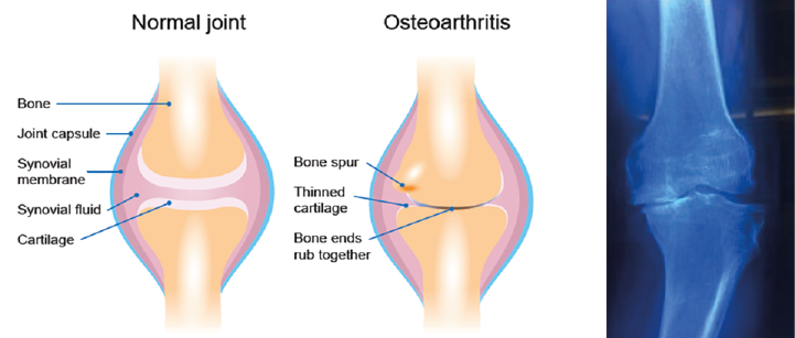 Knee-OA