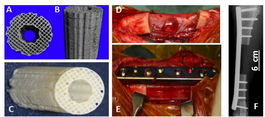 Bone regeneration